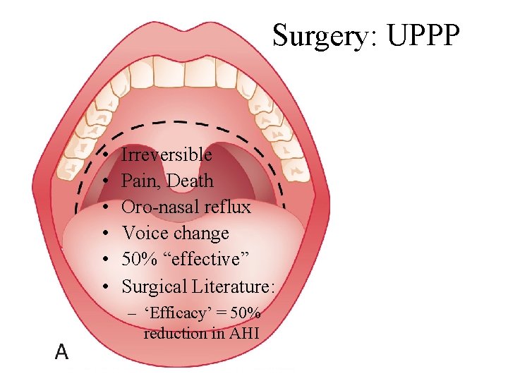 Surgery: UPPP • • • Irreversible Pain, Death Oro-nasal reflux Voice change 50% “effective”