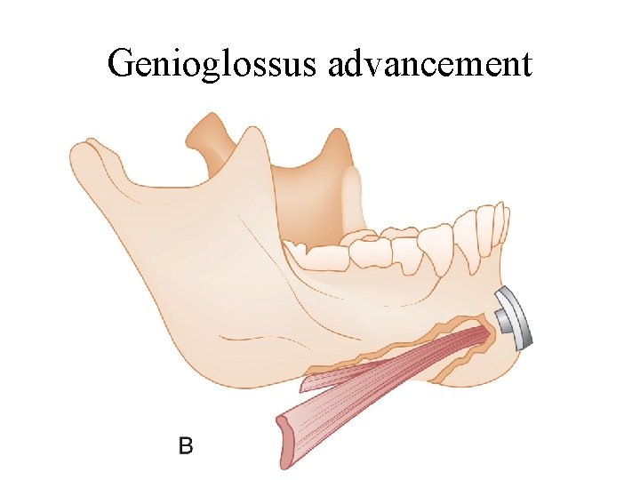 Genioglossus advancement 