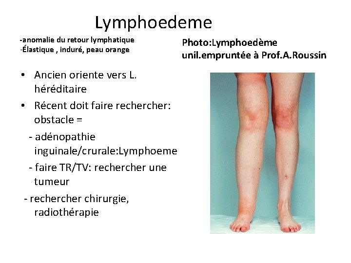 Lymphoedeme -anomalie du retour lymphatique -Élastique , induré, peau orange • Ancien oriente vers