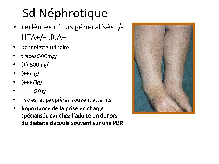 Sd Néphrotique • œdèmes diffus généralisés+/HTA+/-I. R. A+ • • bandelette urinaire traces: 300