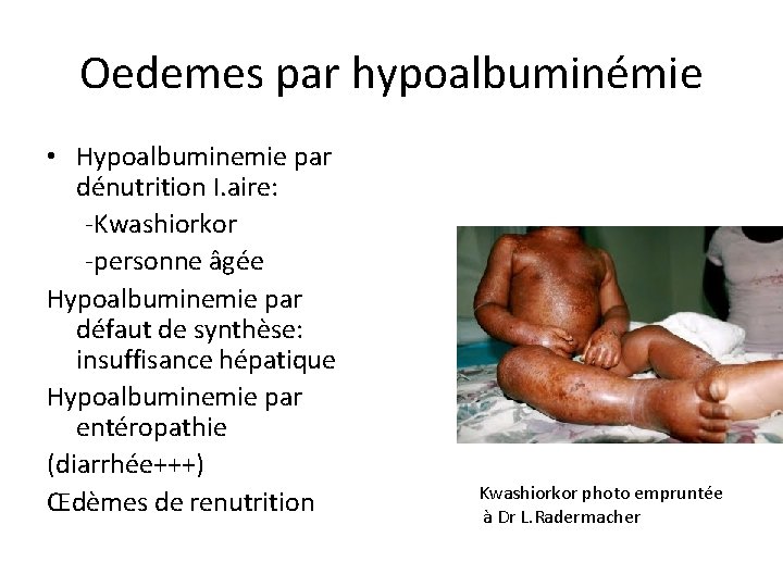 Oedemes par hypoalbuminémie • Hypoalbuminemie par dénutrition I. aire: -Kwashiorkor -personne âgée Hypoalbuminemie par