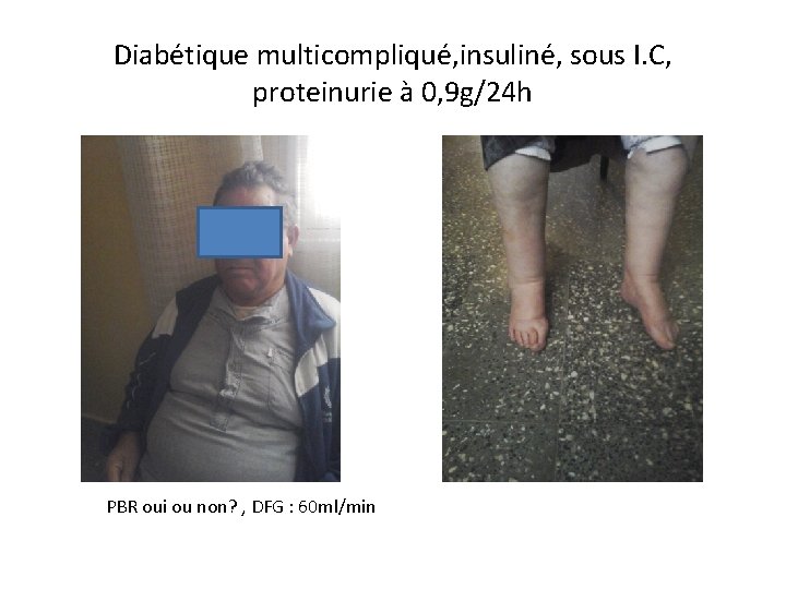 Diabétique multicompliqué, insuliné, sous I. C, proteinurie à 0, 9 g/24 h PBR oui