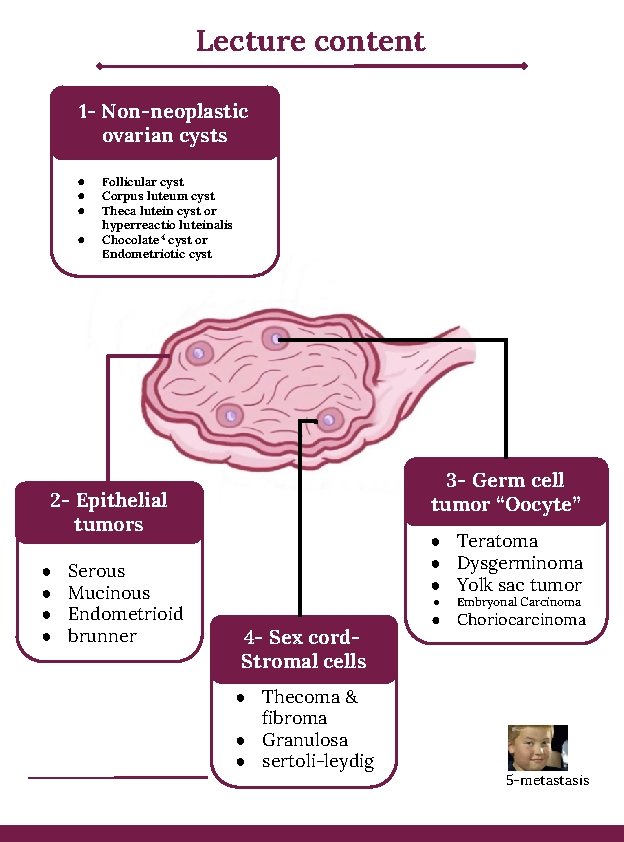 Lecture content 1 - Non-neoplastic ovarian cysts ● ● Follicular cyst Corpus luteum cyst