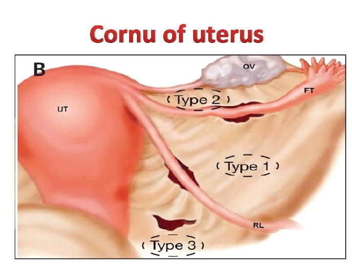 Cornu of uterus 