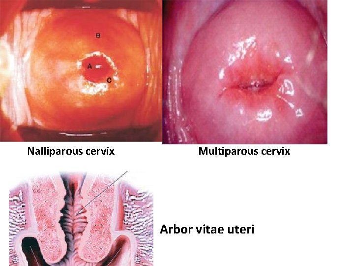 Nalliparous cervix Multiparous cervix Arbor vitae uteri Nalliparous cervix Multiparous cervix Arbor vitae uteri