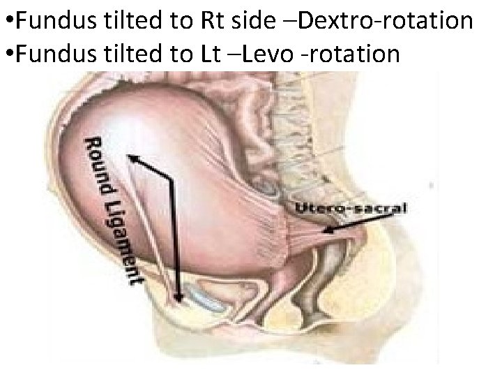  • Fundus tilted to Rt side –Dextro-rotation • Fundus tilted to Lt –Levo