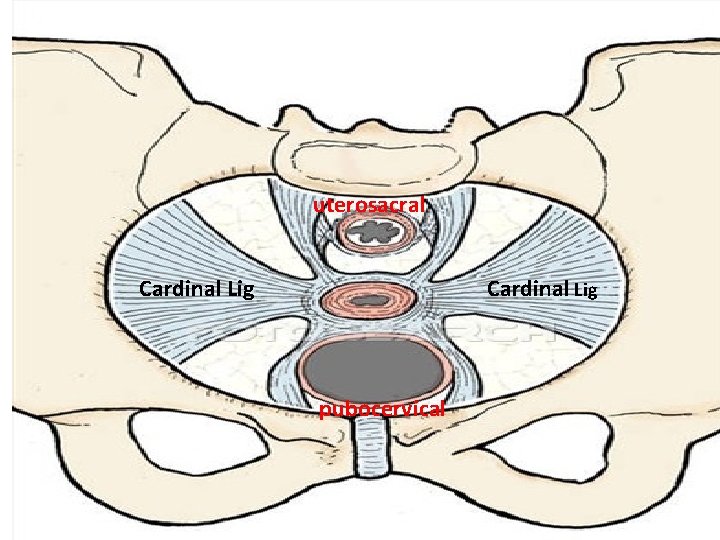 uterosacral Cardinal Lig pubocervical 