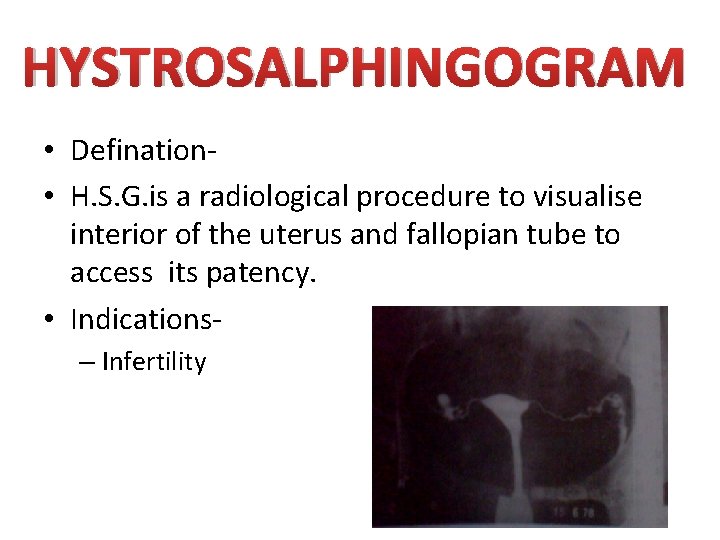 HYSTROSALPHINGOGRAM • Defination • H. S. G. is a radiological procedure to visualise interior