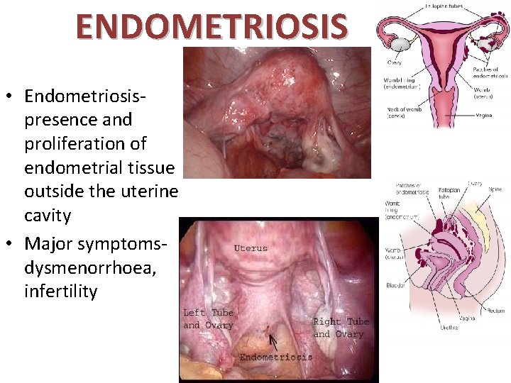 ENDOMETRIOSIS • Endometriosispresence and proliferation of endometrial tissue outside the uterine cavity • Major