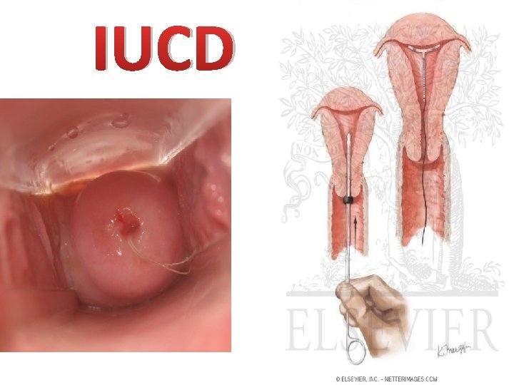 IUCD IUCD