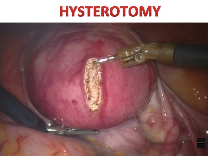 HYSTEROTOMY HYSTEROTOMY
