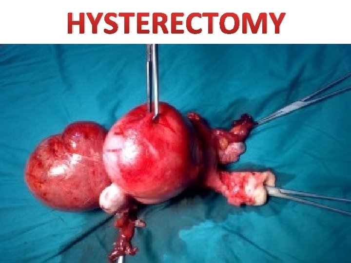 HYSTERECTOMY 