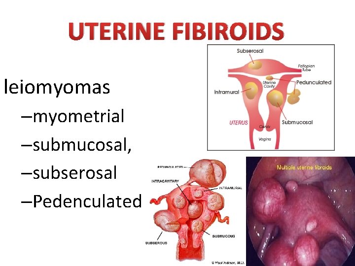 UTERINE FIBIROIDS leiomyomas –myometrial –submucosal, –subserosal –Pedenculated UTERINE FIBIROIDS leiomyomas –myometrial –submucosal, –subserosal –Pedenculated