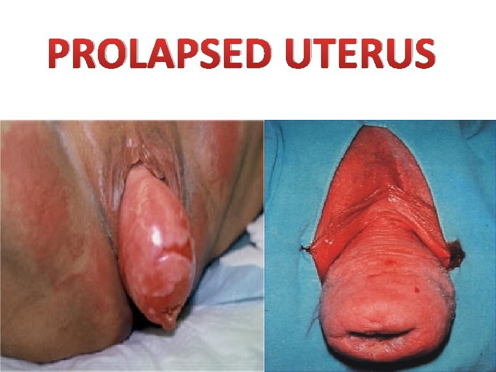 PROLAPSED UTERUS PROLAPSED UTERUS