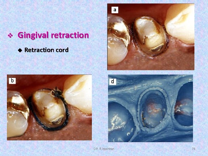 v Gingival retraction u Retraction cord DR. R. koohkan 74 