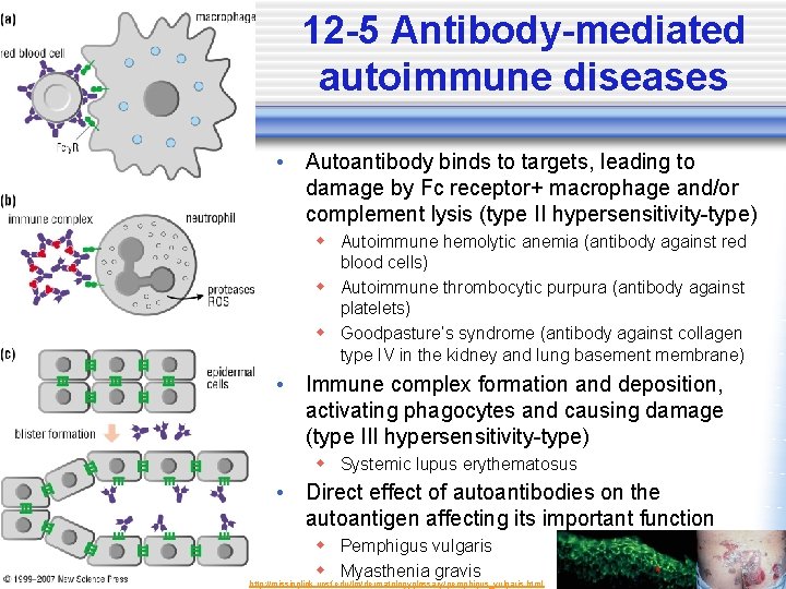 12 -5 Antibody-mediated autoimmune diseases • Autoantibody binds to targets, leading to damage by
