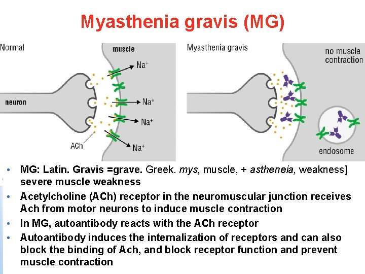 Myasthenia gravis (MG) • MG: Latin. Gravis =grave. Greek. mys, muscle, + astheneia, weakness]