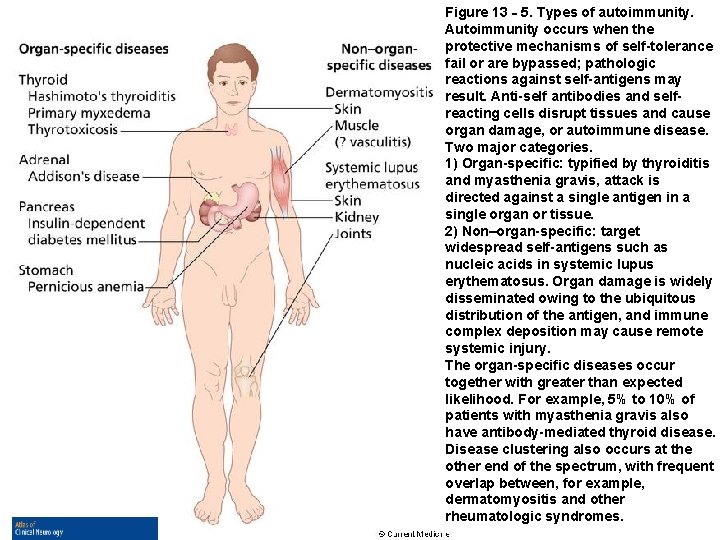 Figure 13‐ 5. Types of autoimmunity. Autoimmunity occurs when the protective mechanisms of self-tolerance