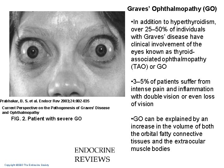 Graves’ Ophthalmopathy (GO) • In addition to hyperthyroidism, over 25– 50% of individuals with