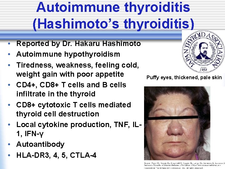 Autoimmune thyroiditis (Hashimoto’s thyroiditis) • Reported by Dr. Hakaru Hashimoto • Autoimmune hypothyroidism •