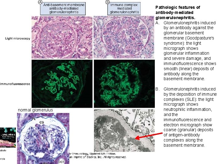Pathologic features of antibody-mediated glomerulonephritis. A. Glomerulonephritis induced by an antibody against the glomerular