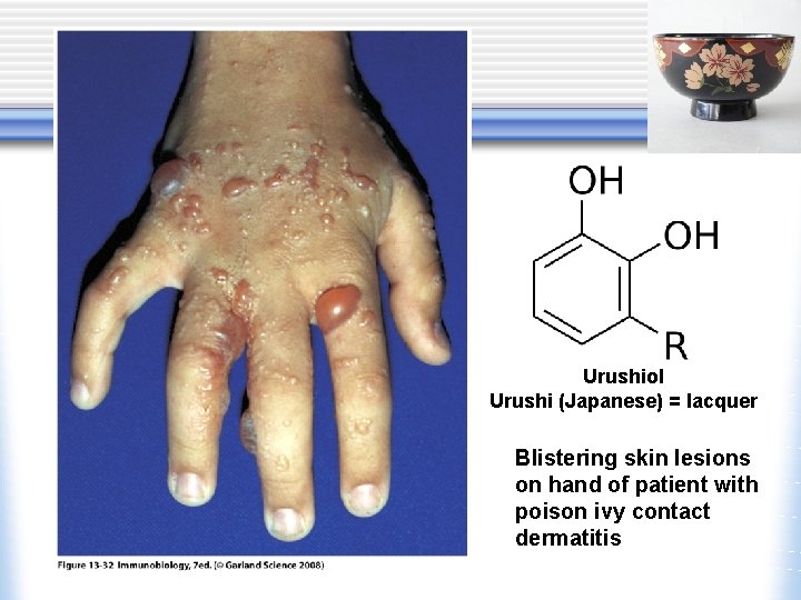 Urushiol Urushi (Japanese) = lacquer Blistering skin lesions on hand of patient with poison