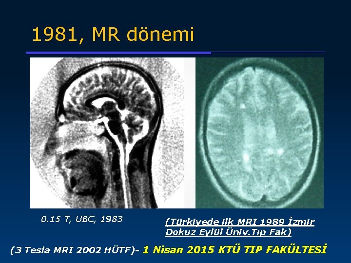 1981, MR dönemi 0. 15 T, UBC, 1983 (Türkiyede ilk MRI 1989 İzmir Dokuz