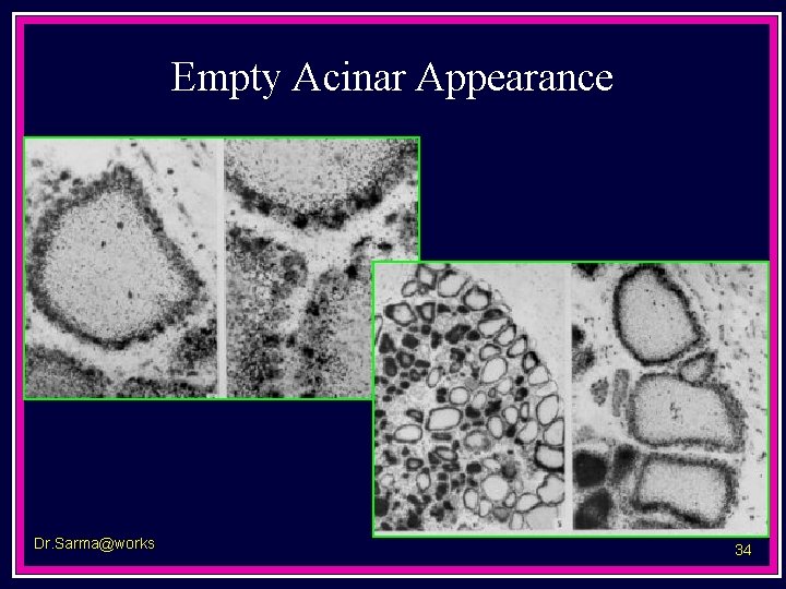 Empty Acinar Appearance Dr. Sarma@works 34 