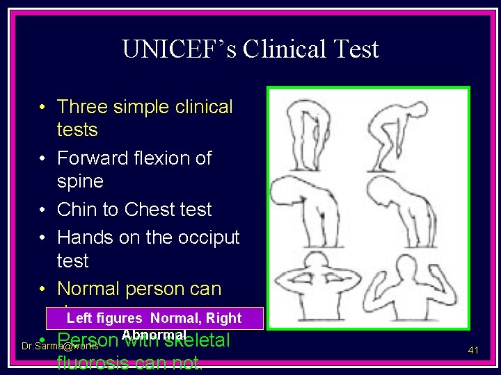 UNICEF’s Clinical Test • Three simple clinical tests • Forward flexion of spine •