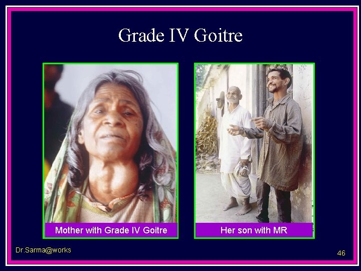 Grade IV Goitre Mother with Grade IV Goitre Dr. Sarma@works Her son with MR