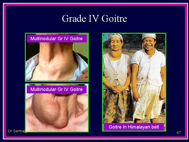Grade IV Goitre Multinodular Gr IV Goitre Dr. Sarma@works Goitre in Himalayan belt 47
