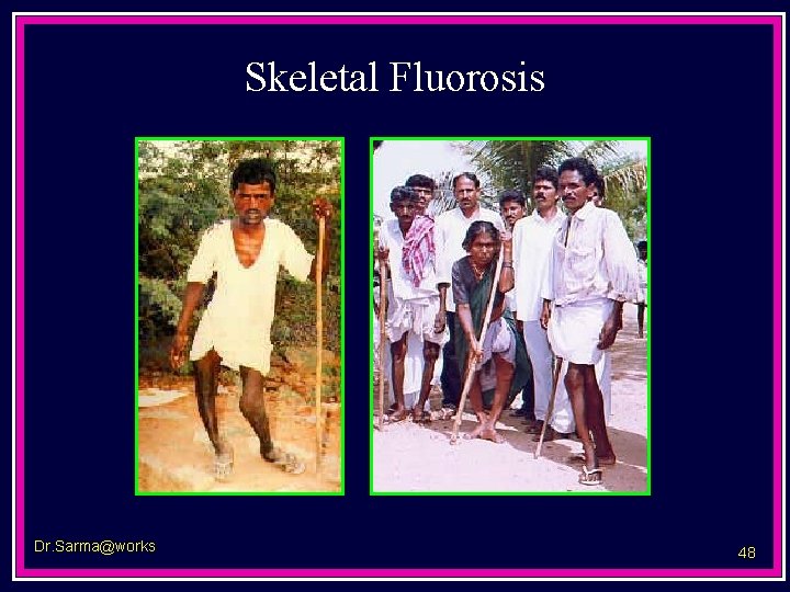 Skeletal Fluorosis Dr. Sarma@works 48 