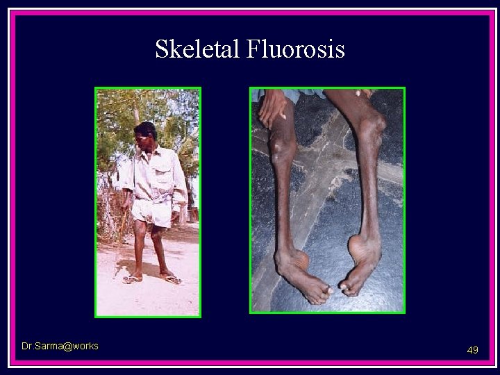 Skeletal Fluorosis Dr. Sarma@works 49 