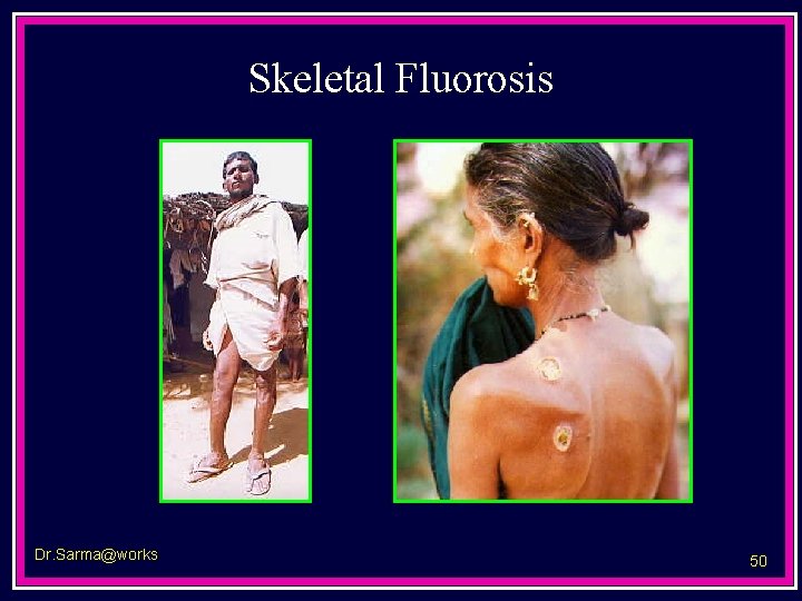 Skeletal Fluorosis Dr. Sarma@works 50 