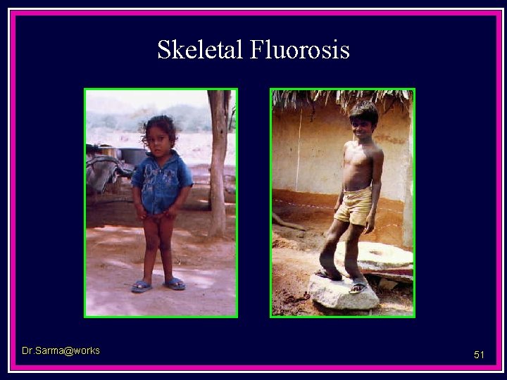 Skeletal Fluorosis Dr. Sarma@works 51 