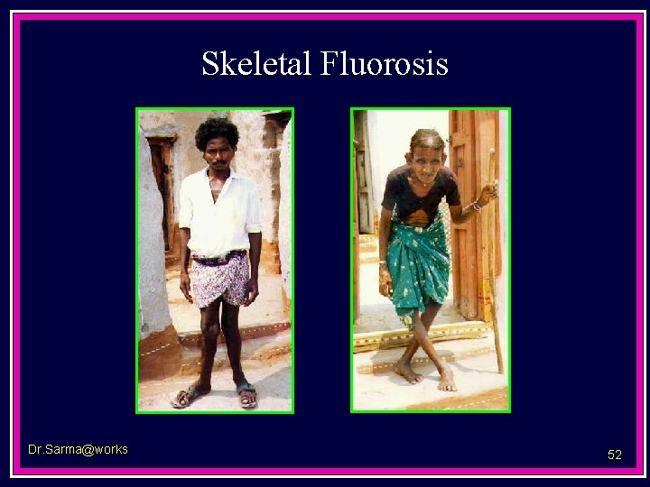 Skeletal Fluorosis Dr. Sarma@works 52 