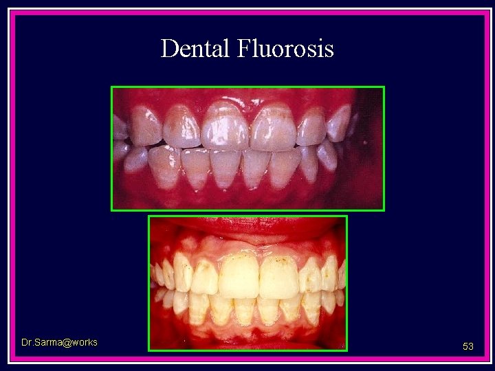 Dental Fluorosis Dr. Sarma@works 53 