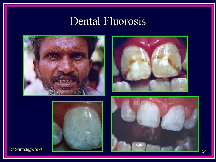 Dental Fluorosis Dr. Sarma@works 54 