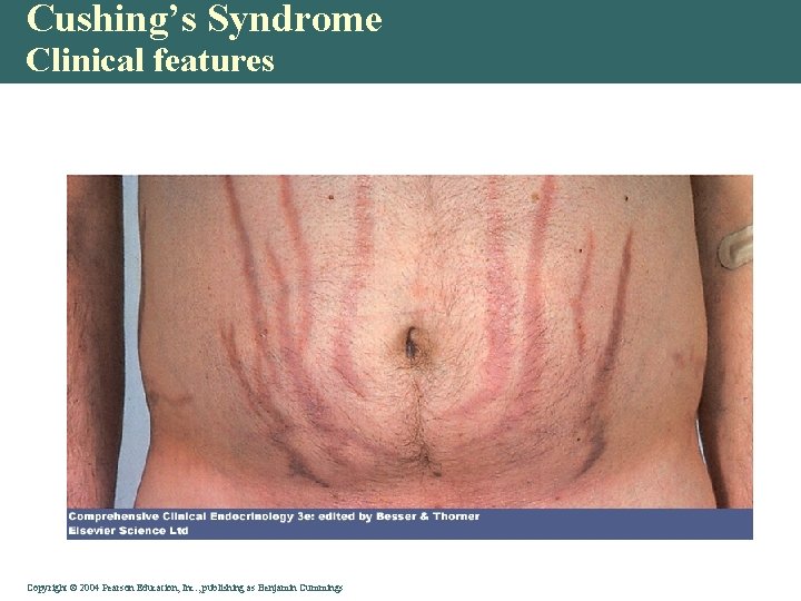 Cushing’s Syndrome Clinical features Copyright © 2004 Pearson Education, Inc. , publishing as Benjamin