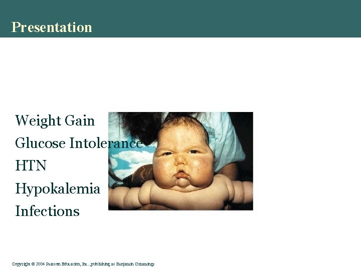 Presentation Weight Gain Glucose Intolerance HTN Hypokalemia Infections Copyright © 2004 Pearson Education, Inc.