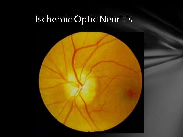 Ischemic Optic Neuritis Ischemic Optic Neuritis