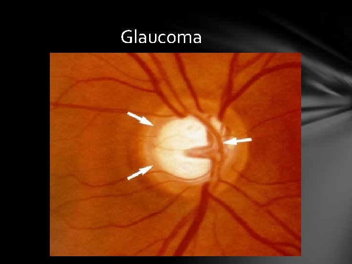 Glaucoma Glaucoma