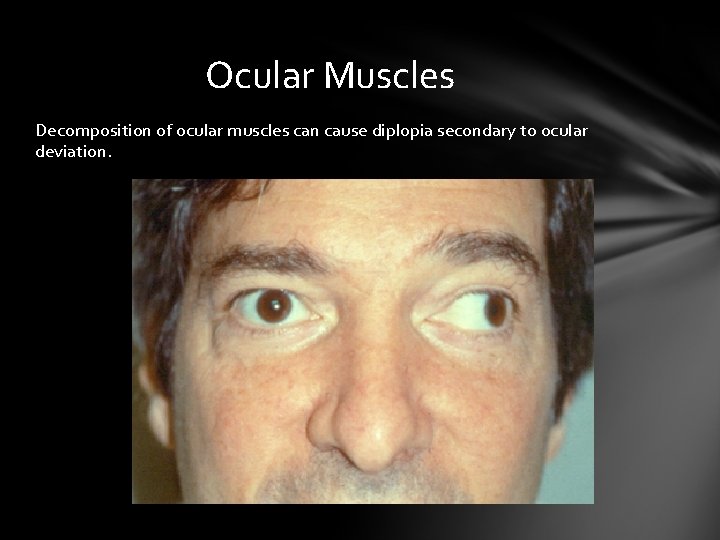 Ocular Muscles Decomposition of ocular muscles can cause diplopia secondary to ocular deviation. Ocular Muscles Decomposition of ocular muscles can cause diplopia secondary to ocular deviation.