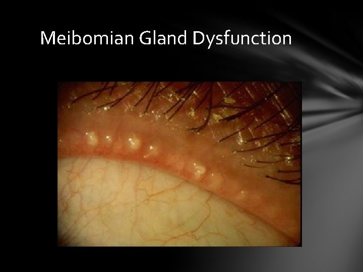 Meibomian Gland Dysfunction Meibomian Gland Dysfunction
