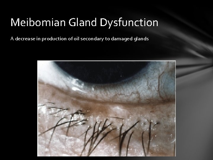 Meibomian Gland Dysfunction A decrease in production of oil secondary to damaged glands Meibomian Gland Dysfunction A decrease in production of oil secondary to damaged glands