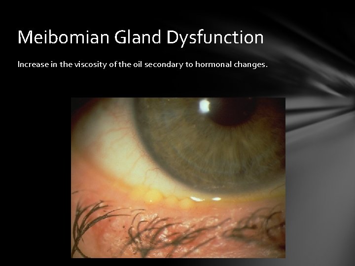 Meibomian Gland Dysfunction Increase in the viscosity of the oil secondary to hormonal changes. Meibomian Gland Dysfunction Increase in the viscosity of the oil secondary to hormonal changes.