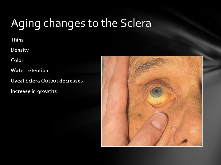 Aging changes to the Sclera Thins Density Color Water retention Uveal Sclera Output decreases Aging changes to the Sclera Thins Density Color Water retention Uveal Sclera Output decreases