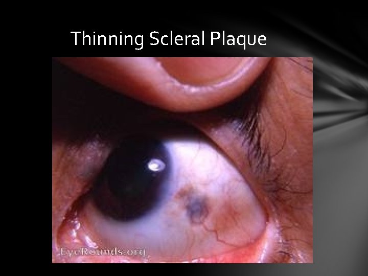 Thinning Scleral Plaque Thinning Scleral Plaque