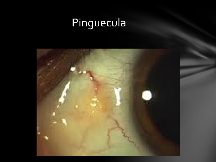 Pinguecula Pinguecula