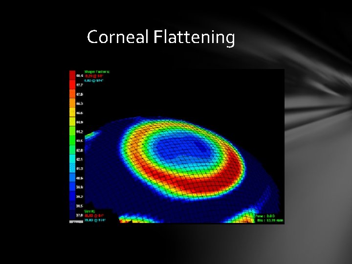 Corneal Flattening Corneal Flattening